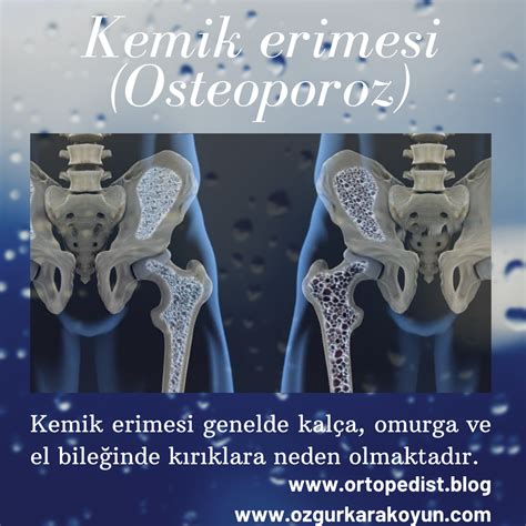 Kemik erimesi (Osteoporoz)